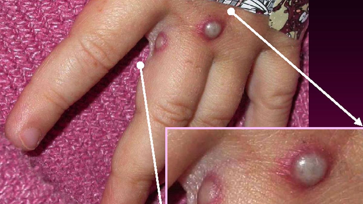 Lesiones cutáneas de viruela de mono en un niño. Lesiones cutáneas de viruela de mono en un niño.