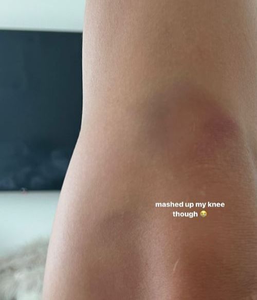 Las secuelas de la caída de Dua Lipa