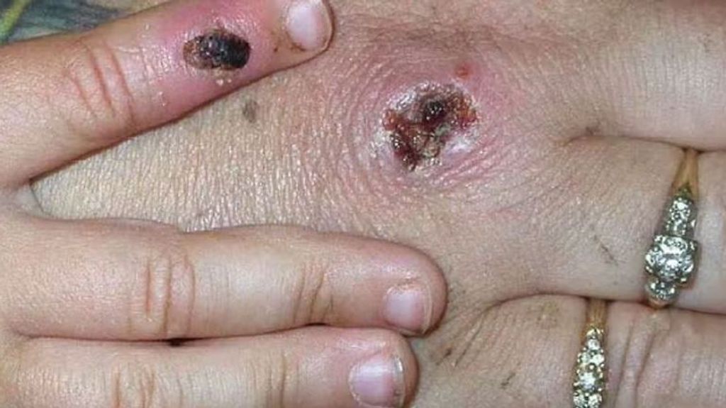 Lesiones viruela de mono