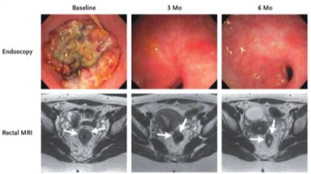 Evolución de la respuesta endoscópica y radiográfica en pacientes representativos tratados con dostarlimab