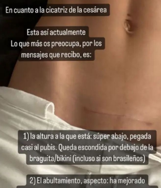 cicatriz de cesarea Carla Barber