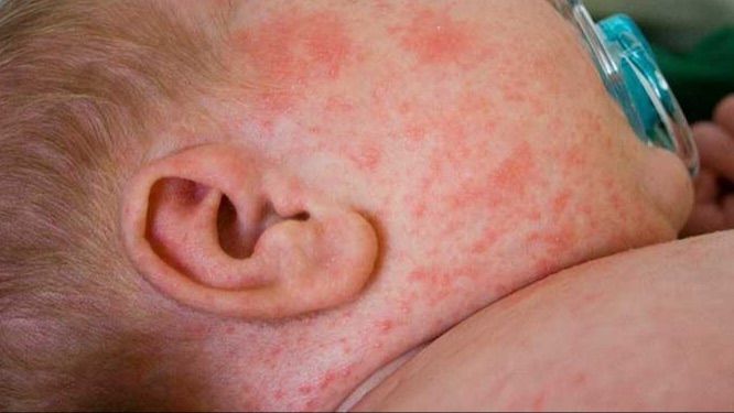 La sudamina se produce en los meses de más calor.