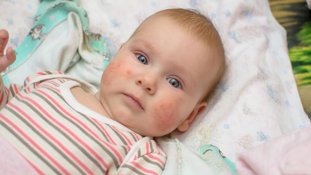 Qué es la sudamina y cómo afecta al bebé.