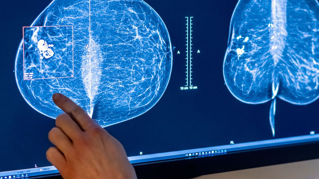 Las células del cáncer de mama aprovechan la noche para propagarse por el cuerpo