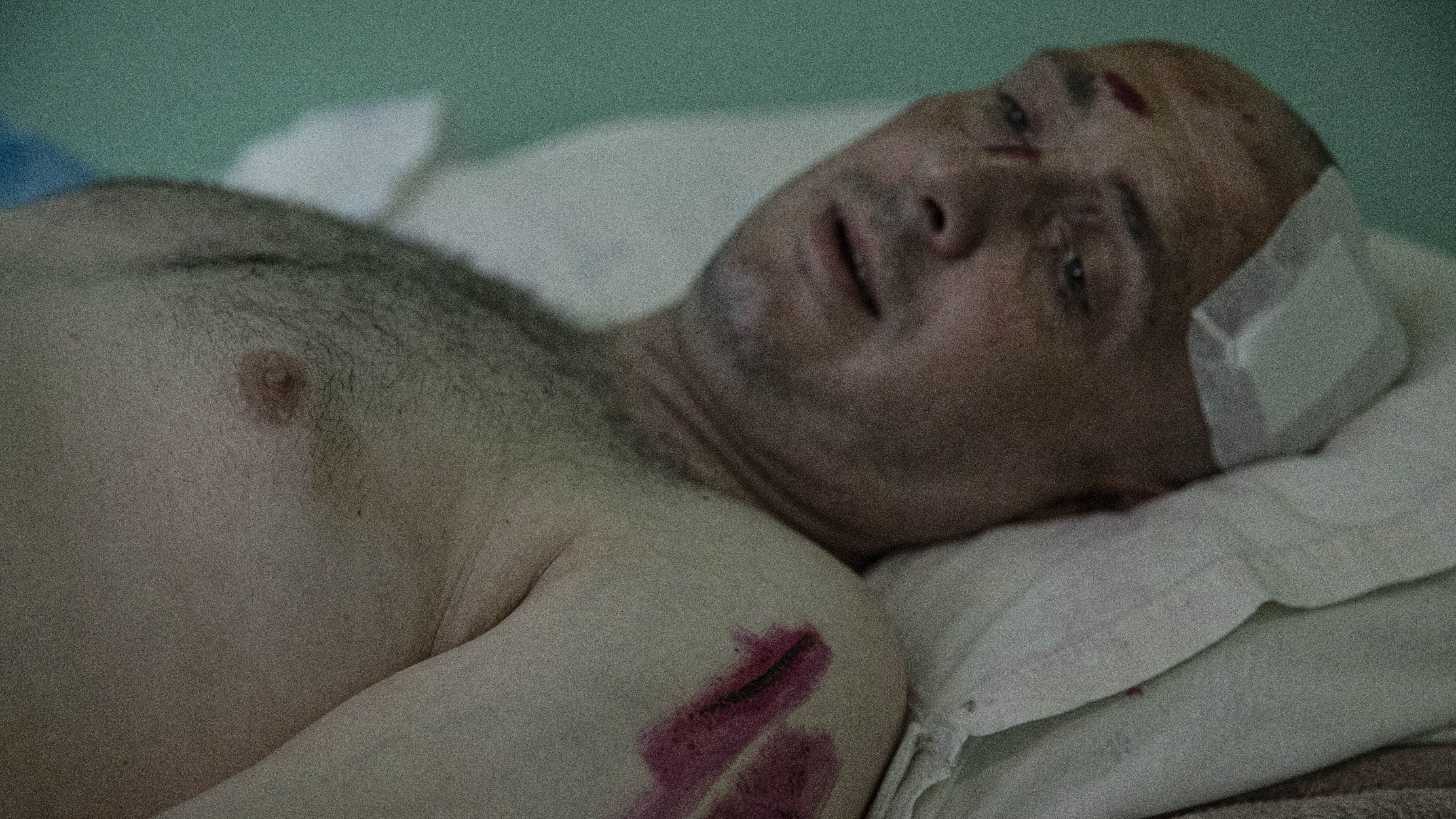 Nikalay Izmaylov, que resultó herido en el centro comercial Amstor de Kremenchuk, recibe tratamiento