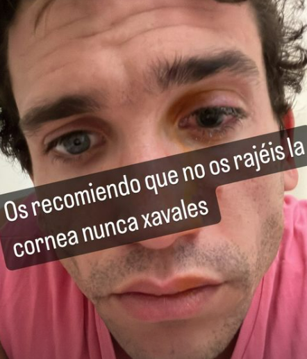 Jaime Lorente, con la córnea rajada