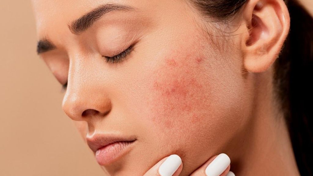 Existen dos tipos de acné.
