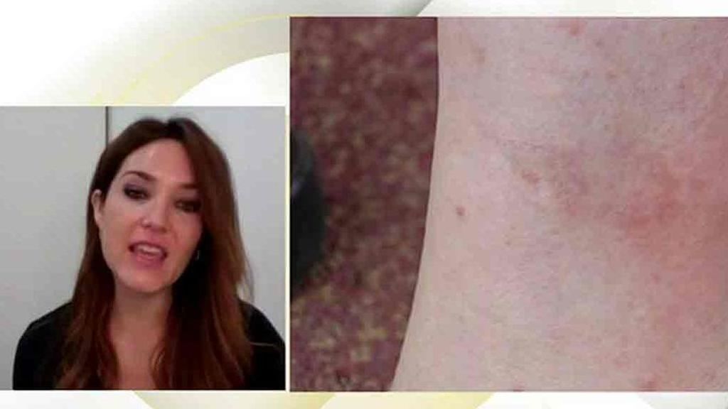 Epidemia de mosca negra: Cómo actuar ante sus mordiscos