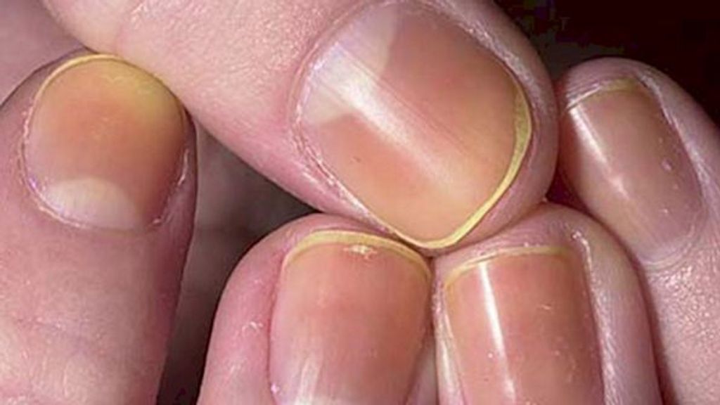 Uñas amarillentas