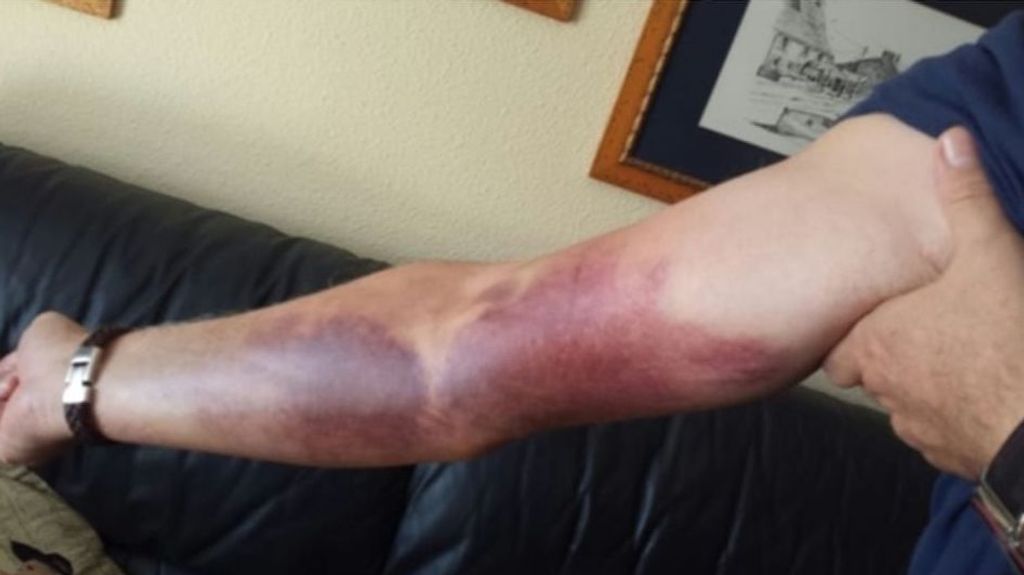 Hematomas sufridos por un funcionario de prisiones tras una agresión