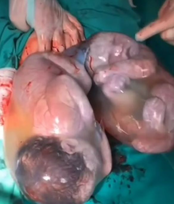 Las gemelas que nacieron mientras aún estaban dentro de sus bolsas amnióticas