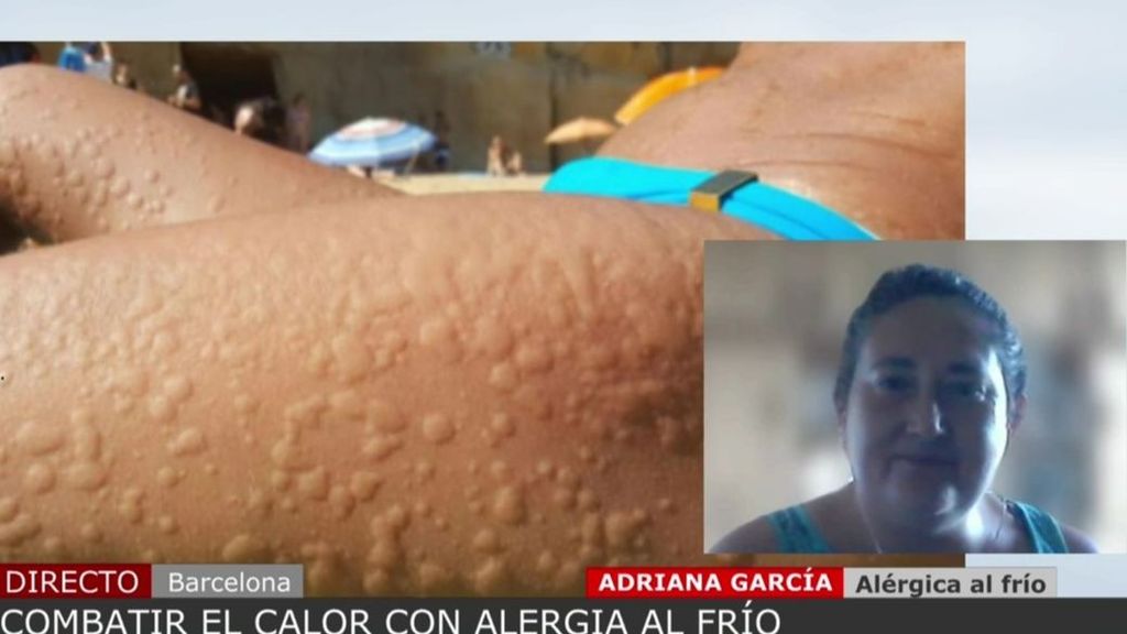 El drama de una persona alérgica al frío con la ola de calor: “Las bajas temperaturas te provocan ronchas y en mi caso anafilaxia”
