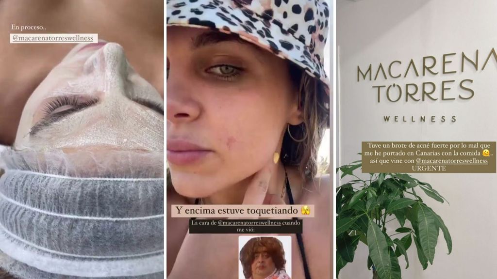 Ivana Icardi ha sufrido un brote de granos en su viaje a Canarias