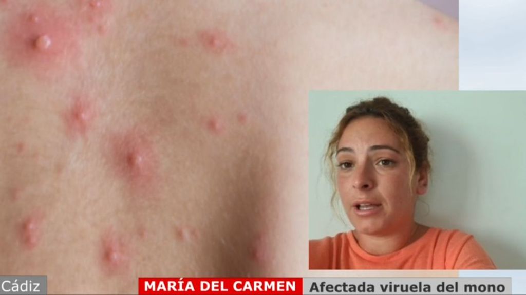 Una infectada del brote de viruela del mono en Cádiz emprende medidas contra el local de tatuajes: "Estoy aislada"
