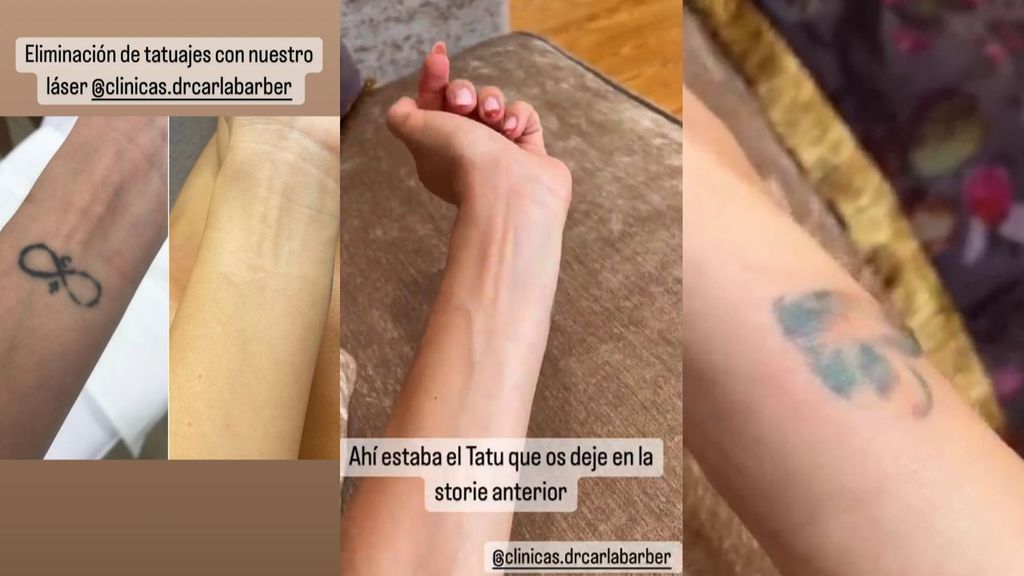 Carla Barber elimina sus tatuajes