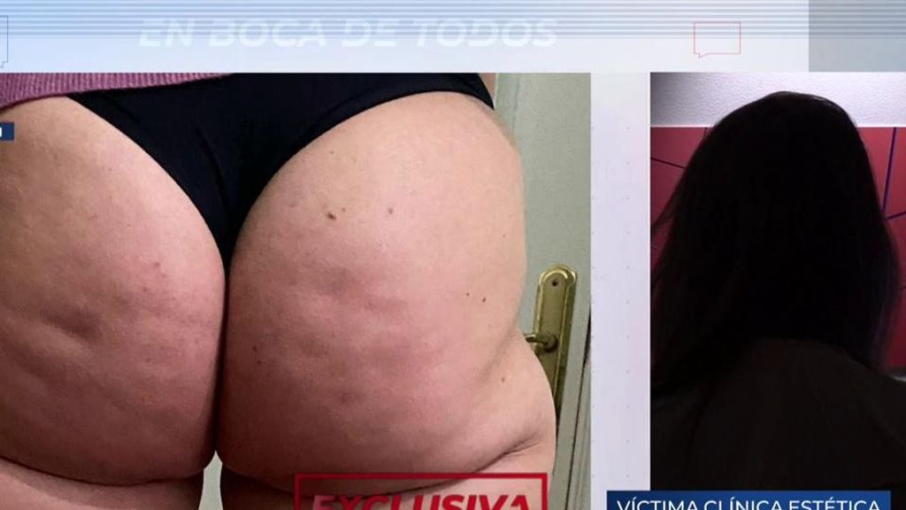 Víctima de la clínica estética en la que operaron a Silvia, fallecida tras una negligencia: "Me han amenazado con denunciarme por injurias"