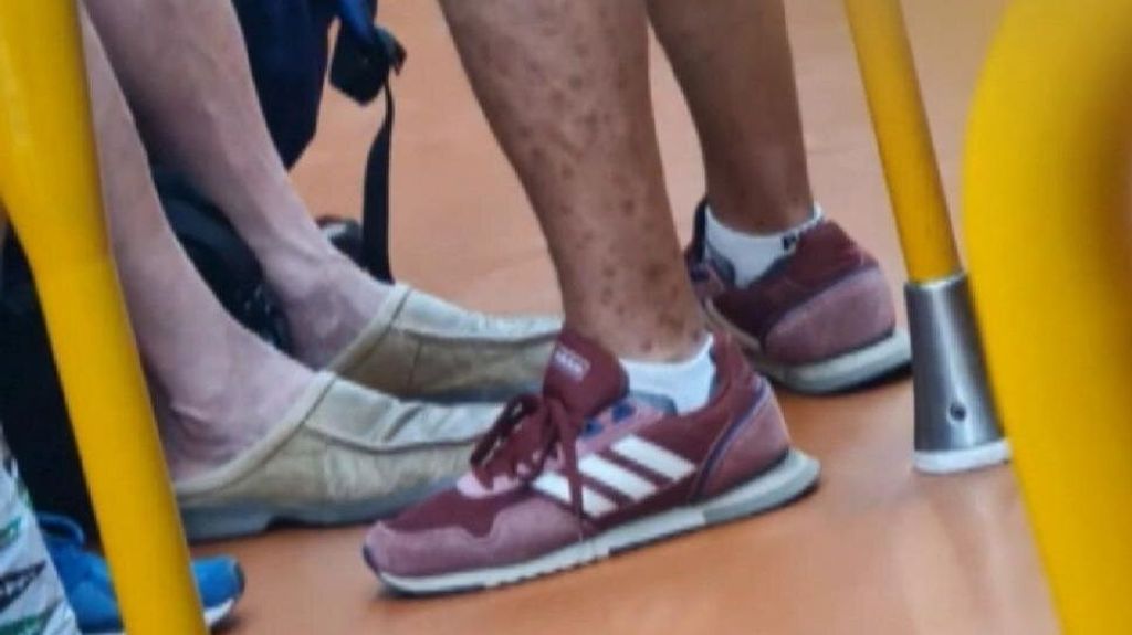 Imagen viral del supuesto hombre con viruela del mono en el metro de Madrid