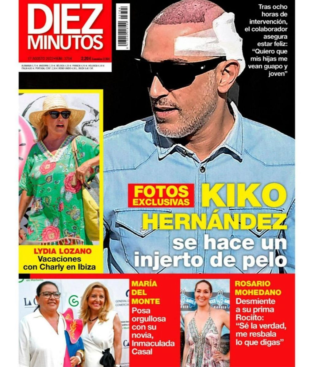Kiko Hernández se ha sometido a un injerto capilar