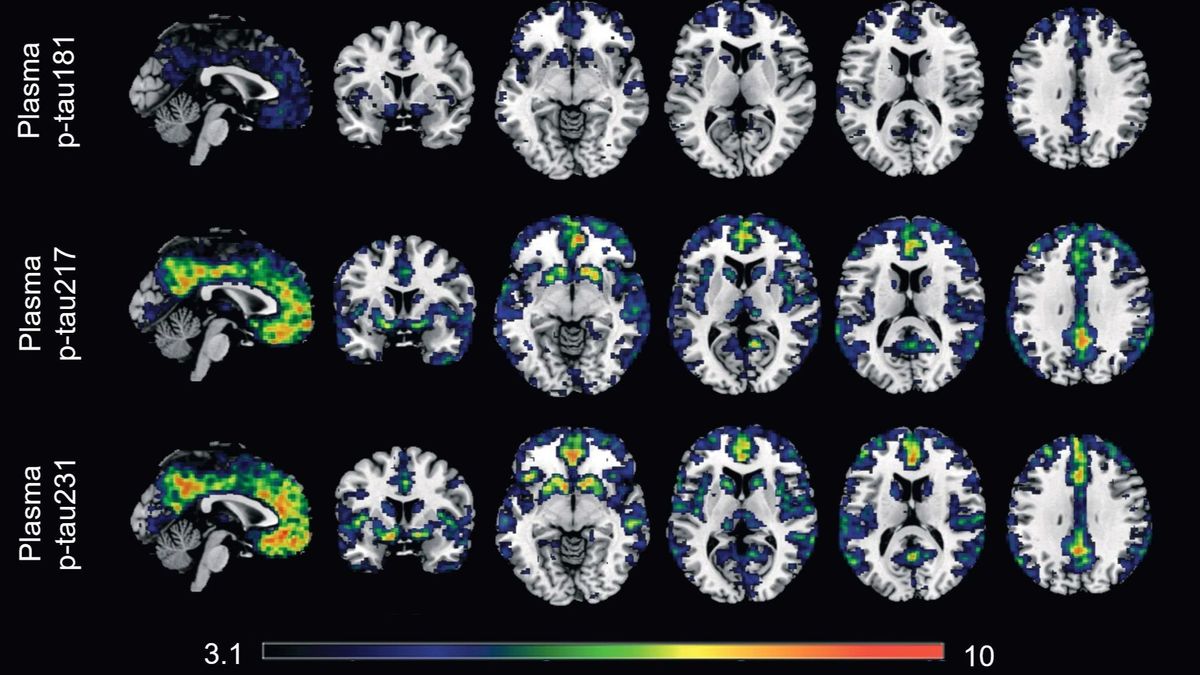 Un estudio identifica dos biomarcadores en sangre para captar los primeros indicios del Alzheimer Un estudio identifica dos biomarcadores en sangre para captar los primeros indicios del Alzheimer