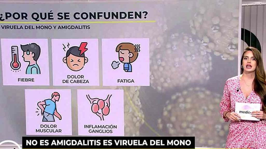 ¿Cómo saber si tengo amigdalitis o viruela del mono?