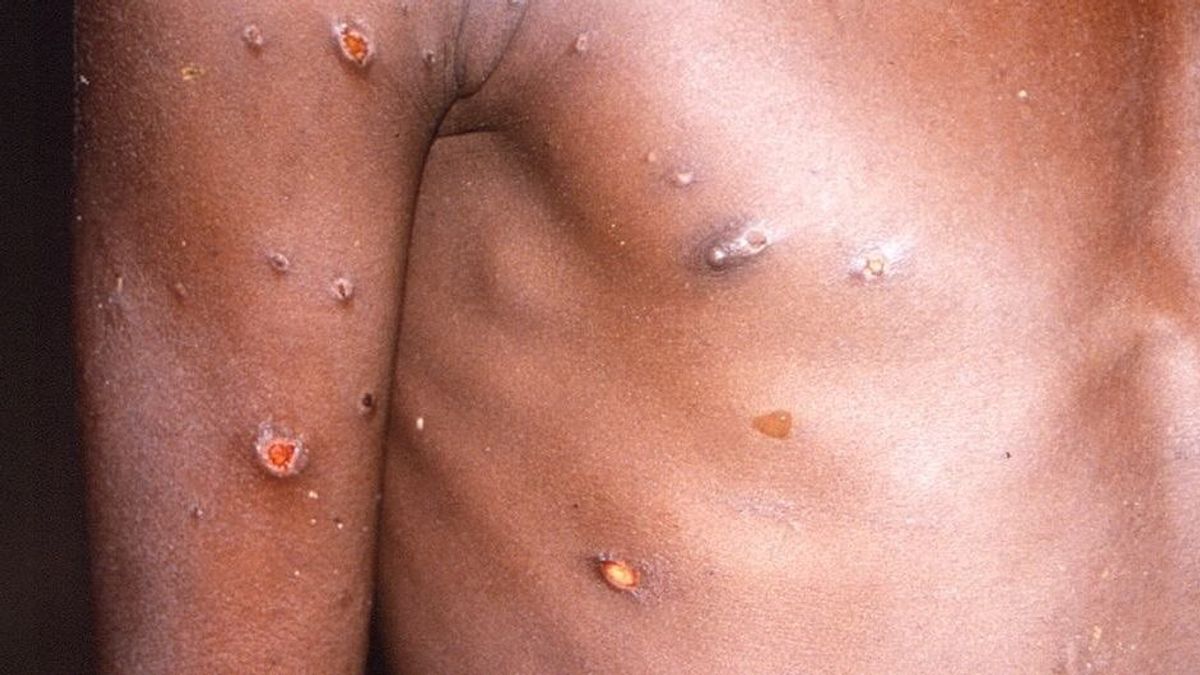 La viruela del mono produce lesiones cutáneas, fiebre y dolor corporal en las personas afectadas por el virus La viruela del mono produce lesiones cutáneas, fiebre y dolor corporal en las personas afectadas por el virus