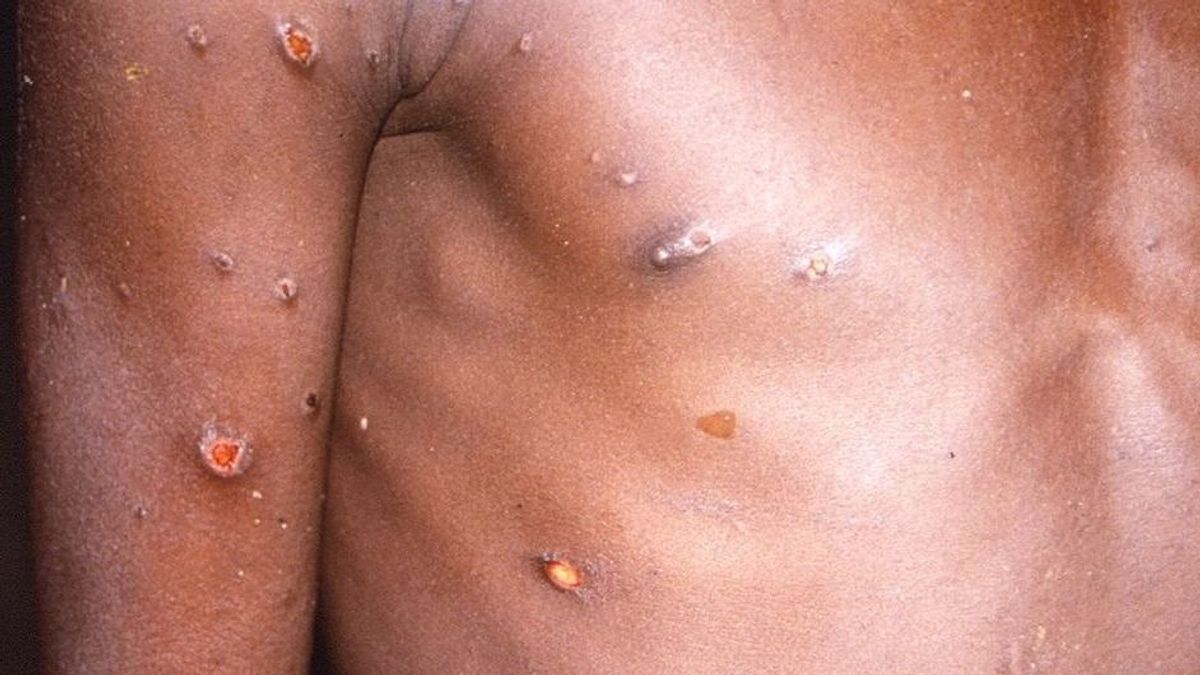 EuropaPress 4557724 viruela mono produce lesiones cutaneas fiebre dolor corporal personas EuropaPress 4557724 viruela mono produce lesiones cutaneas fiebre dolor corporal personas