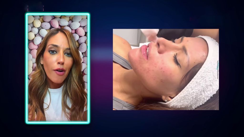 Miriam Saavedra muestra cómo es su lucha contra el acné (Nuria Marín)