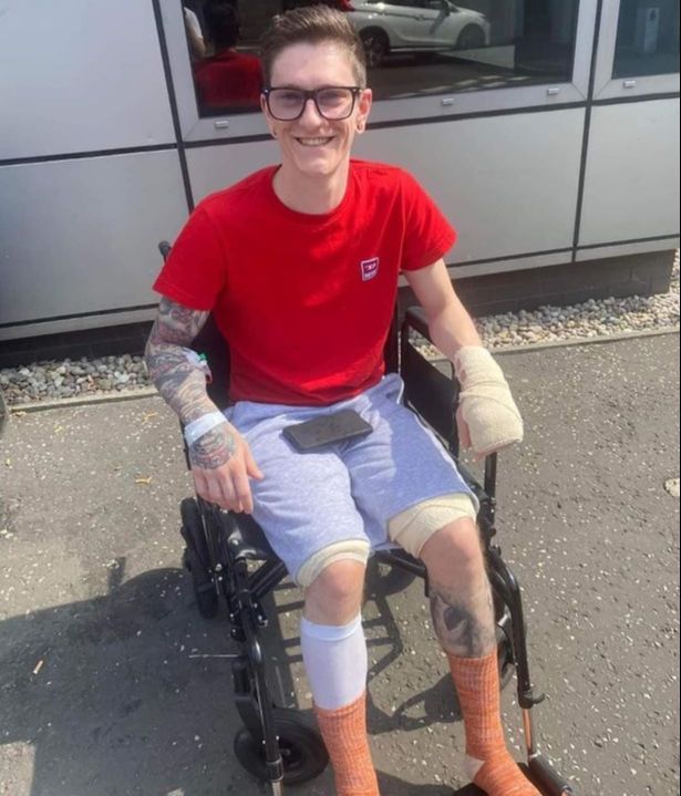 Las heridas que le causó la explosión de un cigarrillo electrónico a un joven de 26 años