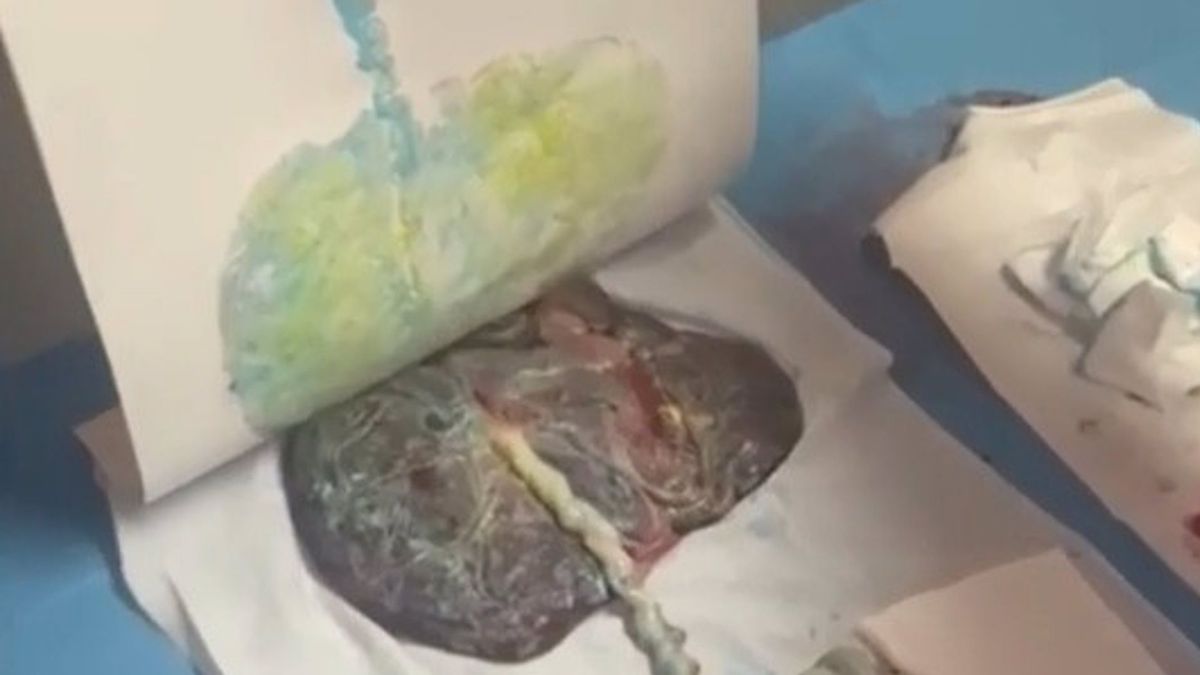 placenta placenta