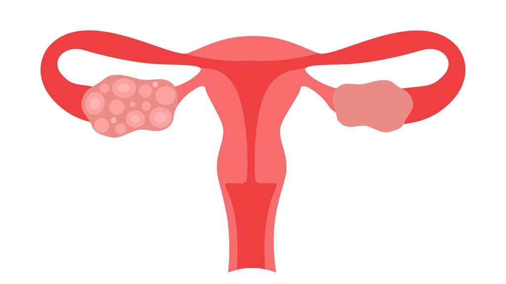 Ilustración de un ovario con quiste y otro sin quiste