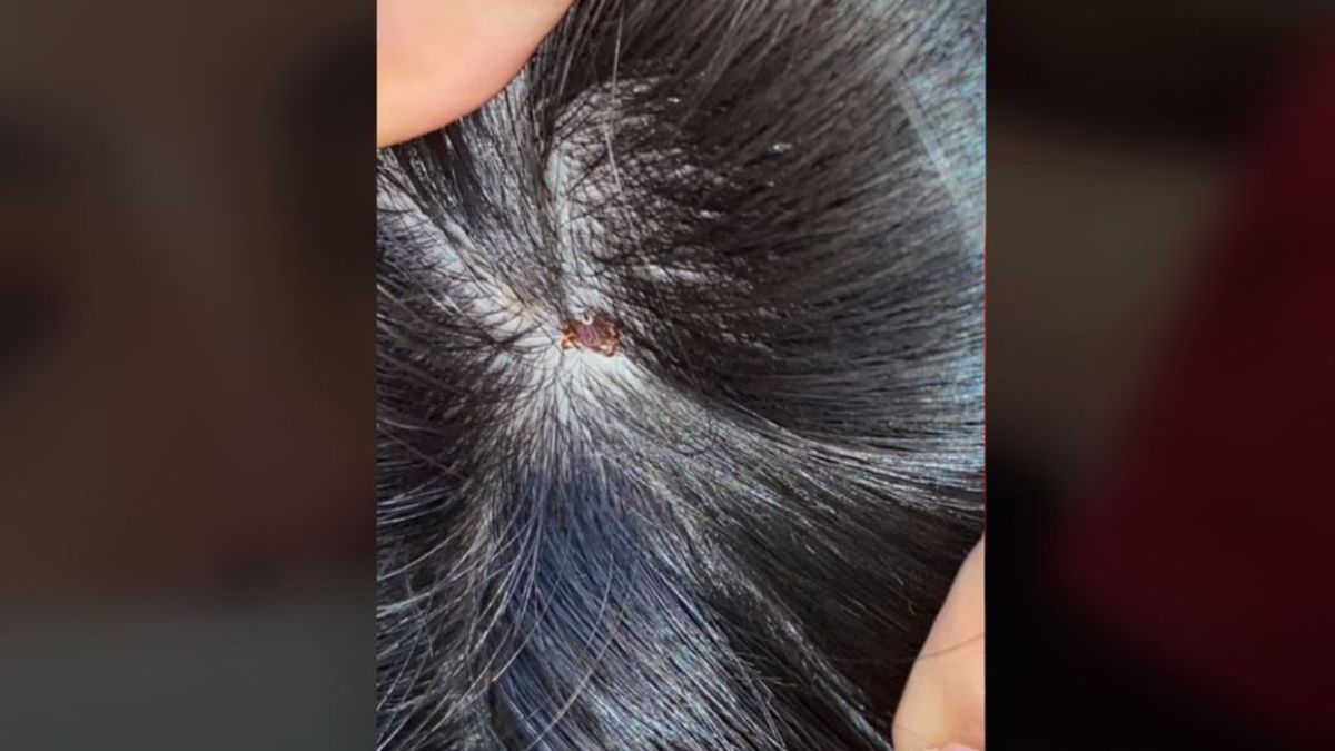 Viral en TikTok el hallazgo de una joven: se encuentra una "costra con patas" en la cabeza