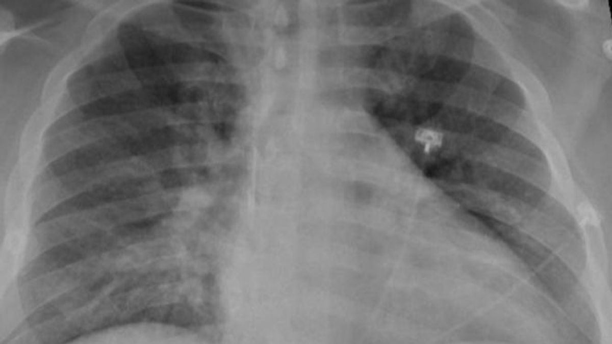 EuropaPress 3456789 radiografia torax paciente positivo covid 19 muestra neumonia parte