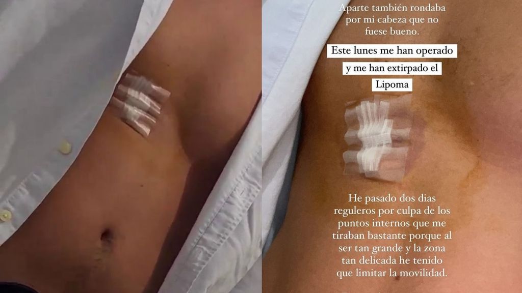 Jesús Sánchez se somete a una intervención quirúrgica para que le extirpen un lipoma