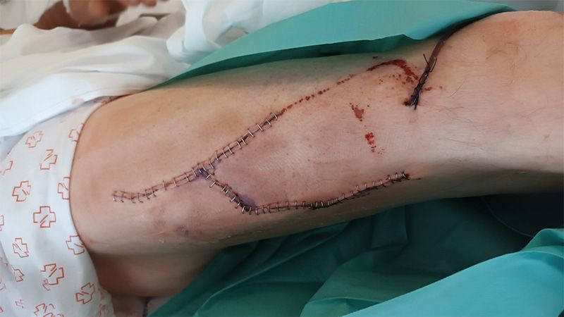 A hunter needs 52 staples in his leg after being attacked by a wild boar in Lugo
