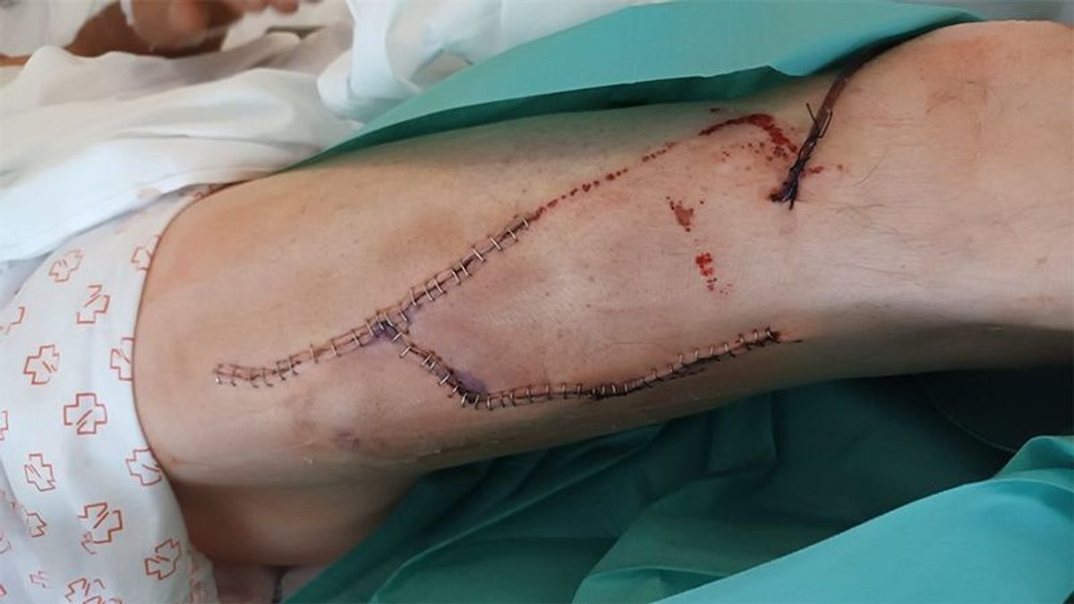 Un cazador necesita 52 grapas en su pierna tras ser  atacado por un jabalí en Lugo
