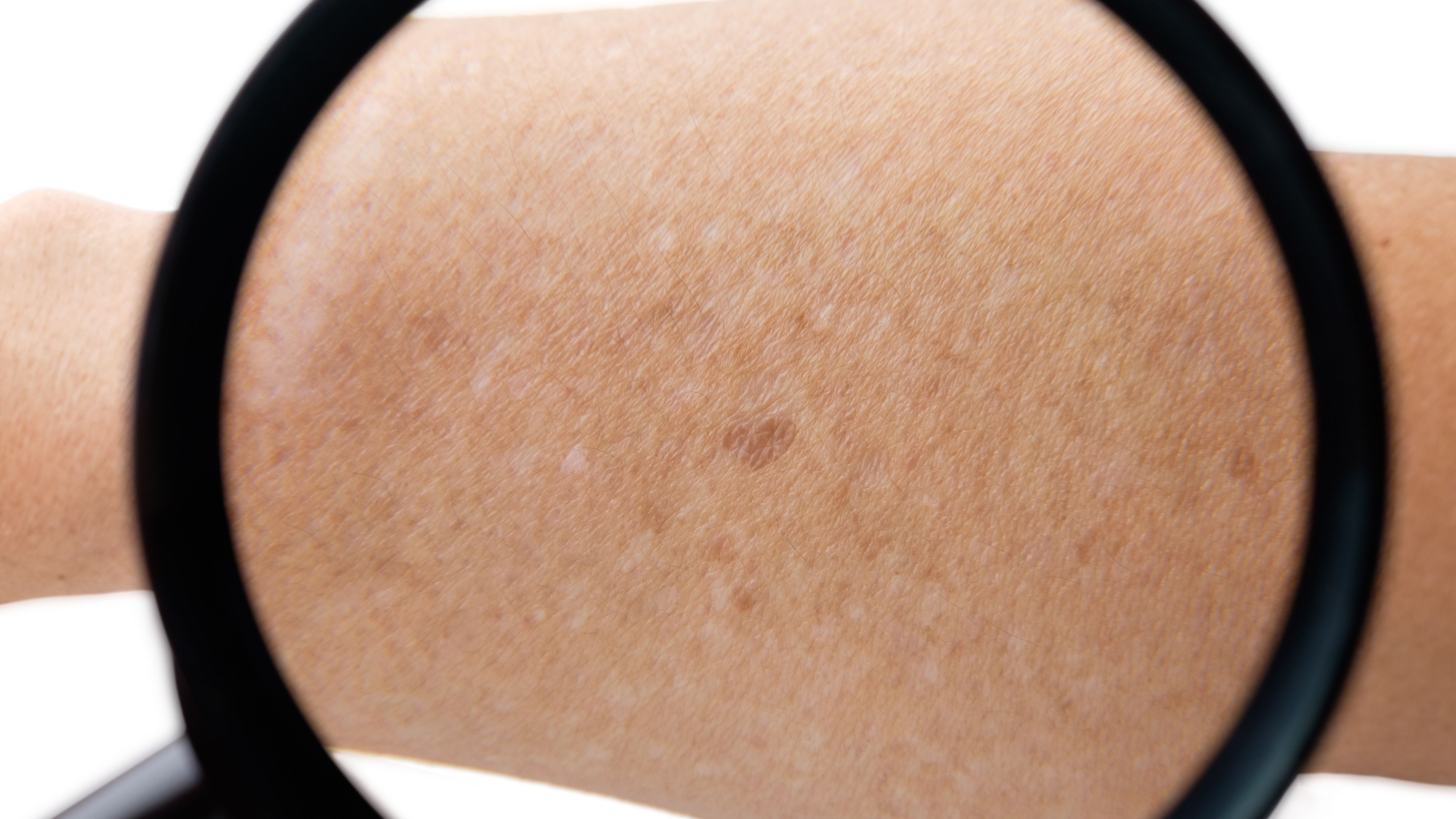 Facilitar Ciego Competir Manchas blancas en la piel: causas, como evitarlas y tratamiento