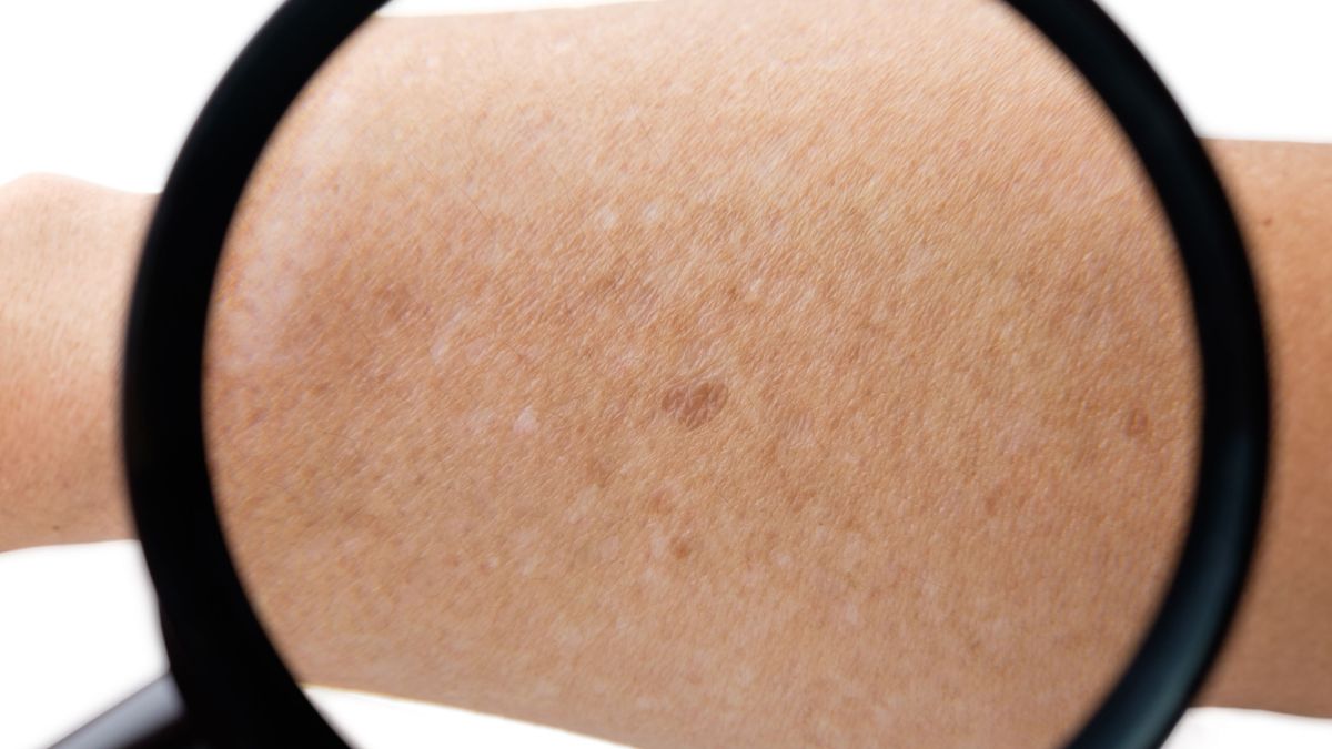 ¿Por qué aparecen manchas blancas en la piel?