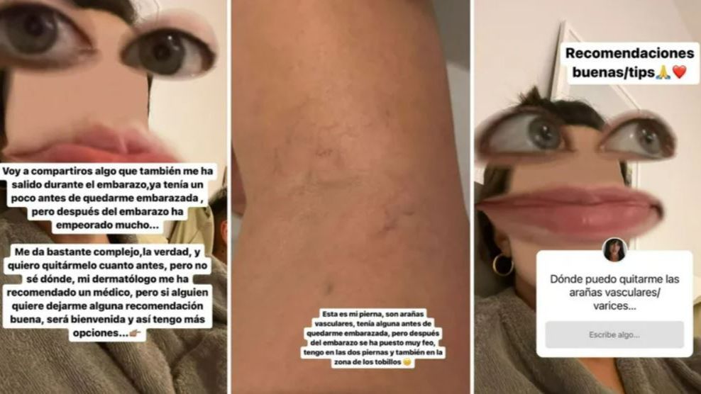 Violeta Mangriñán muestra las arañas vasculares que le han aparecido tras dar a luz
