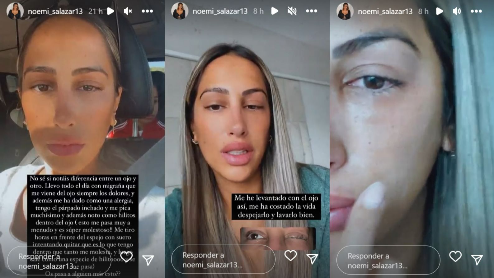 Noemí Salazar muestra su ojo hinchado