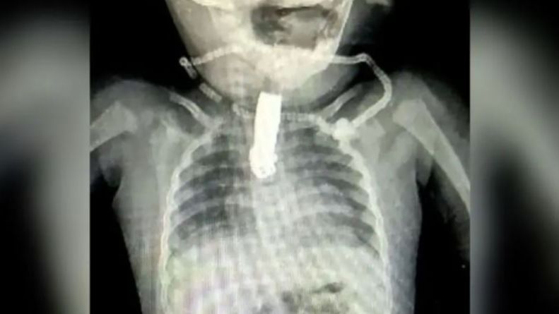 Un niño se traga un cortaúñas de cinco centímetros