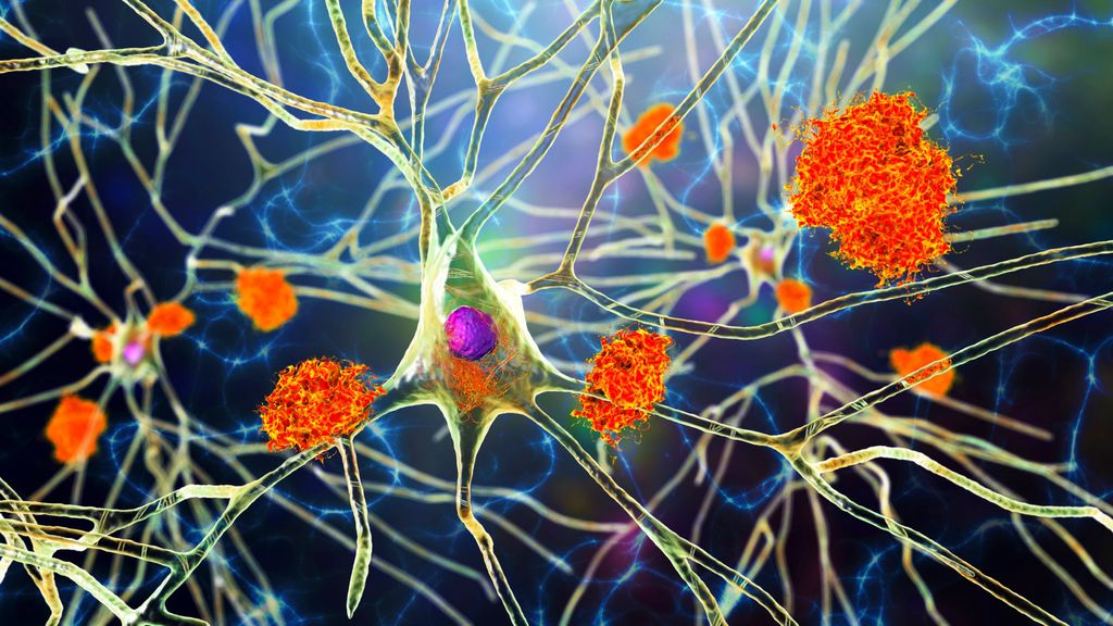 Preguntas sin resolver, optimismo y cautela tras el anuncio de un nuevo fármaco contra el alzhéimer