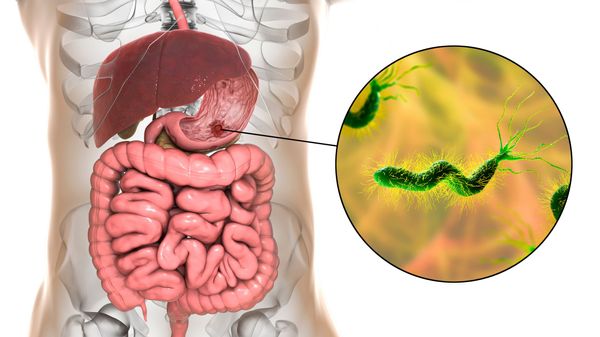 Infección por Helicobacter pylori: qué implica para la salud
