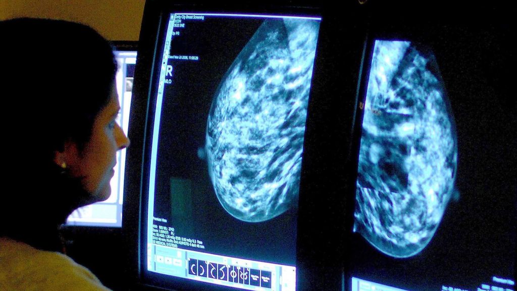 El cáncer de mama es uno de los más comunes entre las mujeres.