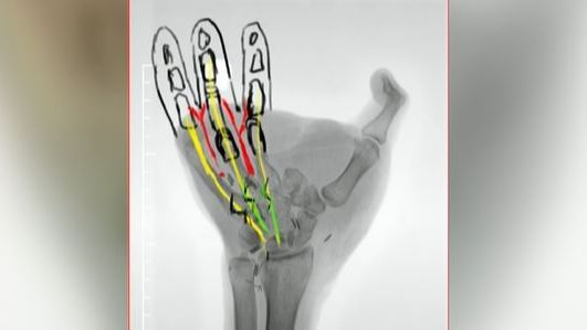 Diego, el joven al que van a implantar tres dedos del pie en la mano