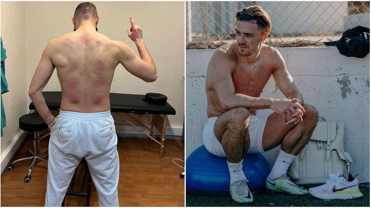 cupping cupping