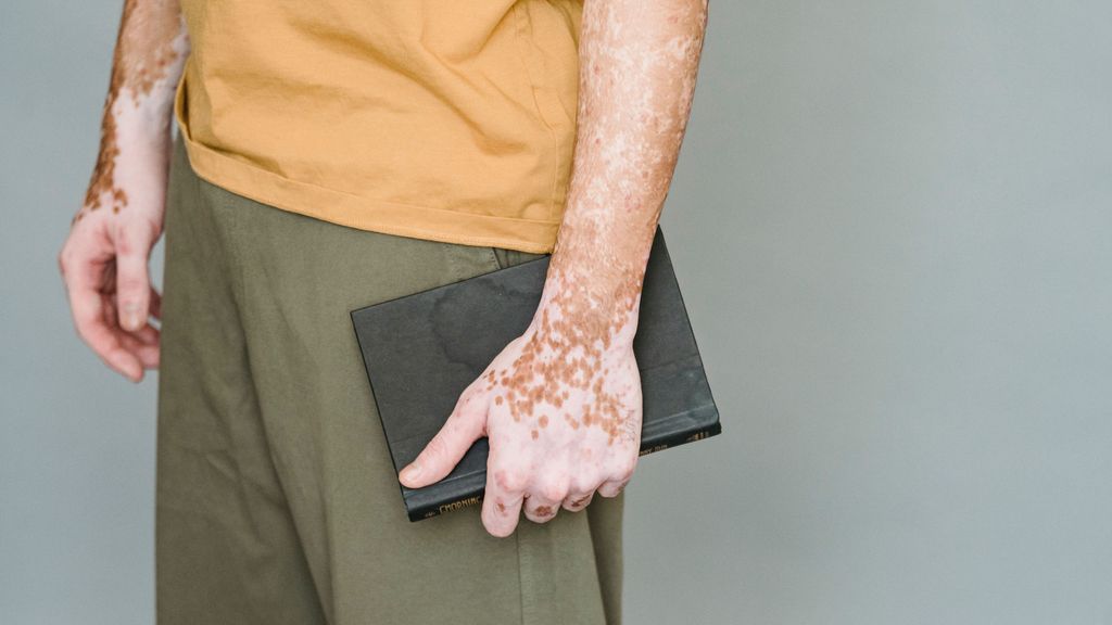 vitiligo