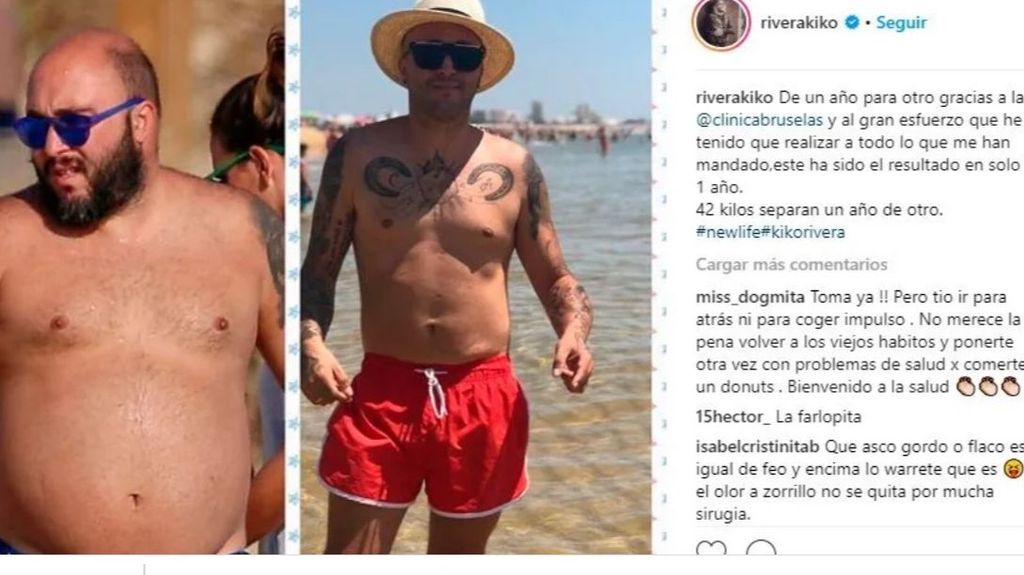 El antes y después de Kiko Rivera con la banda gástrica