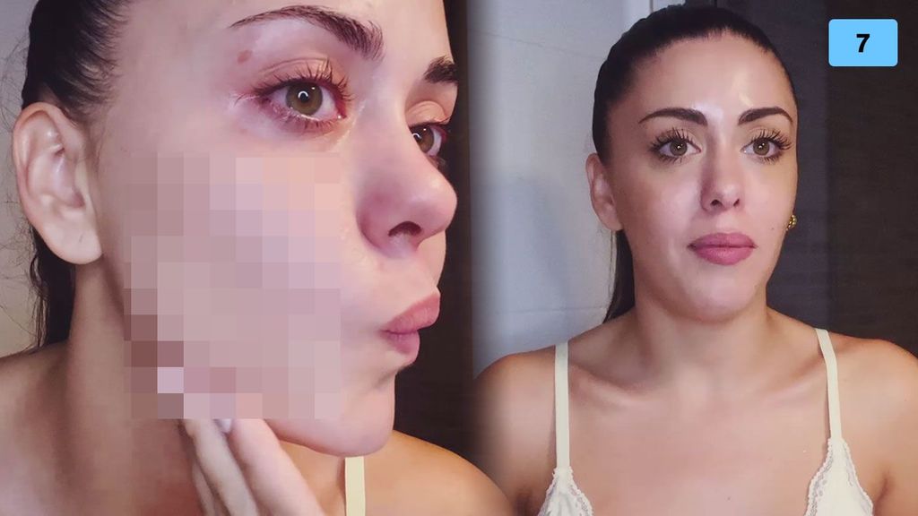 Rosario Matew habla de su problema de acné y muestra su cara sin maquillaje (2/2)