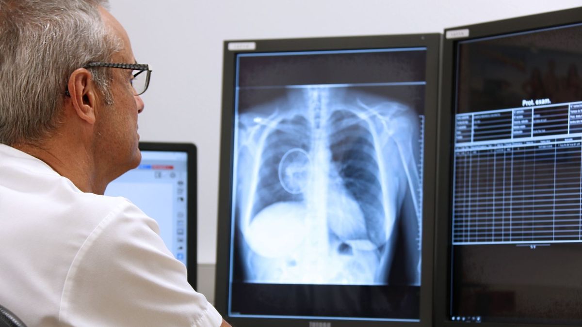 Nódulos pulmonares Nódulos pulmonares