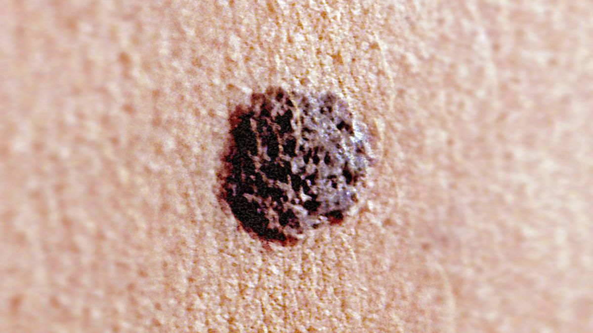 Un estudio ofrece nuevas dianas terapéuticas para prevenir el melanoma